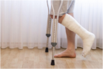 Lower leg encased in a white plaster cast, with the person using metallic underarm crutches for mobility