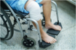 person sitting in a wheelchair with a thick white bandage or wrap covering their right knee and lower leg area